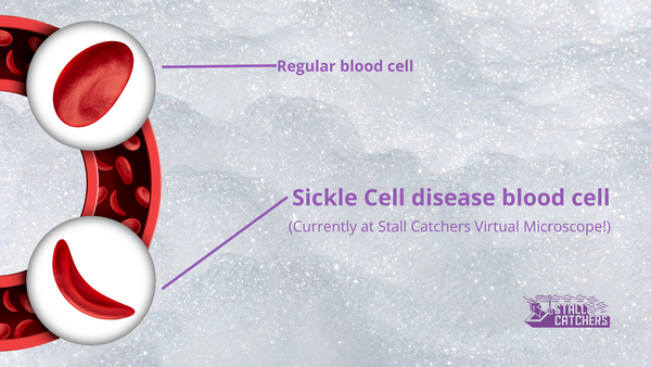 Sickle Cell data in Stall Catchers??